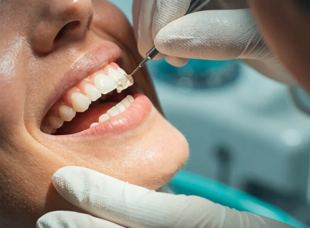 Composite Bonding